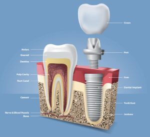 Protesi o Dente Vero?